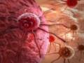 Инфекции и рак: что могут означать распухшие миндалины?
