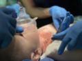Ребенку впервые в Украине пересадили кожу от посмертного донора