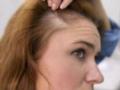 Їжа для здорових волосся: які продукти допоможуть зупинити випадіння волосся