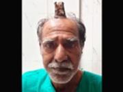 Индийцу удалили из головы 10-сантиметровый рог