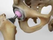 Не только возраст: почему тазобедренный сустав приходится менять и в 30, и в 60 лет