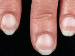 Дефицит железа и гайморит: о каких проблемах со здоровьем расскажут ногти