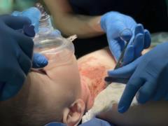 Ребенку впервые в Украине пересадили кожу от посмертного донора