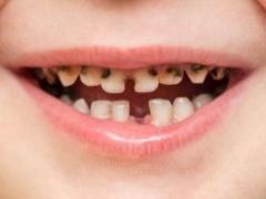 Користь кисломолочних продуктів для здоров я зубів: Запобігання карієсу