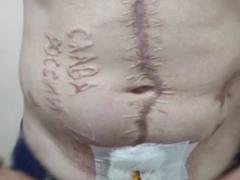 Врачи показали, как проходит лечение украинского защитника с выжженной надписью  Слава России 